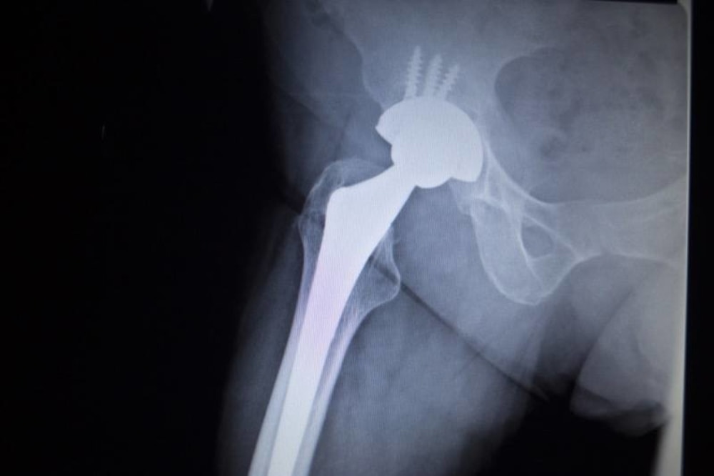 joint replacement brooklyn ny rehab nursing home