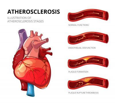 Atherosclerosis Symptoms: Frequently Asked Questions