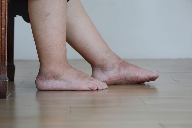 pictures of swollen ankles due to kidney problems