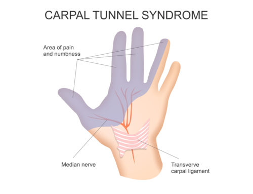 Carpal Tunnel Information: What You Should Know